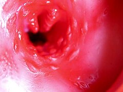 मैसिव लंड होल भरता है